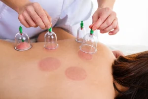 Cupping Therapy in Dubai
